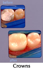 CEREC Crowns - before/after