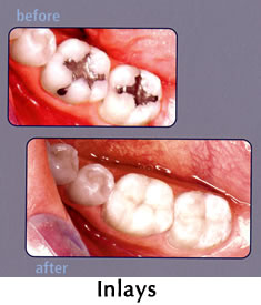 CEREC Inlays - before/after