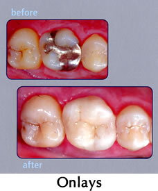 CEREC Onlays - before/after