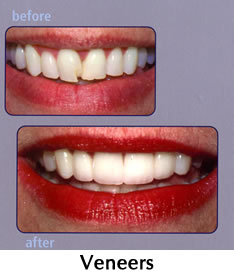 Veneers - before/after